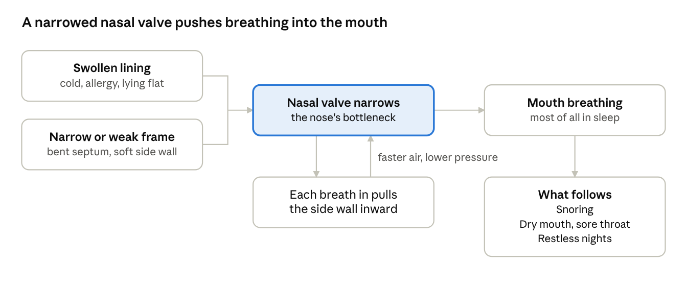 Swelling and a narrow frame shrink the valve; each breath in pulls the soft side wall further in, so the body falls back on mouth breathing.