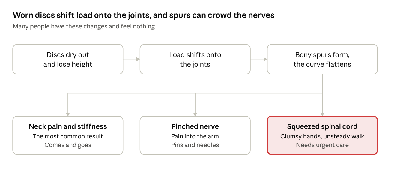 Worn discs shift load onto the joints and spurs can crowd the nerves: neck pain and stiffness are the usual result, a pinched nerve or a squeezed spinal cord less often.