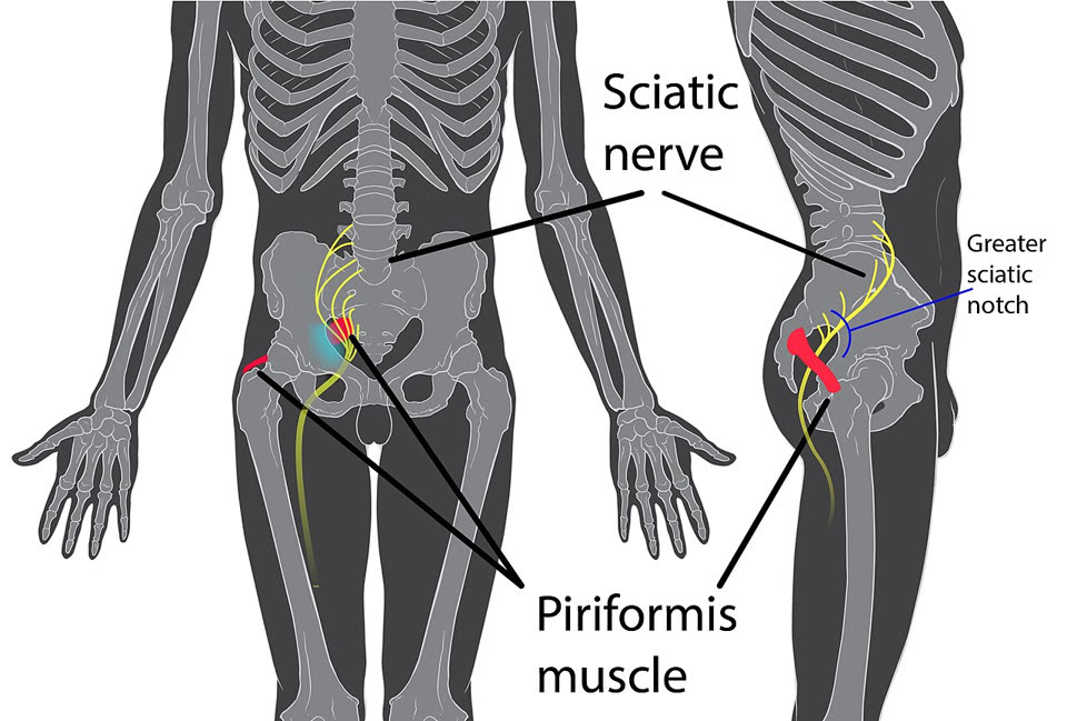 Posterior view of the hip: the piriformis, in red, crosses over the sciatic nerve, in yellow, at the greater sciatic notch.